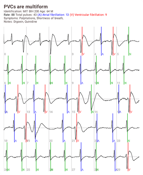 Compartir imagen de ECG Compartir imagen de ECG