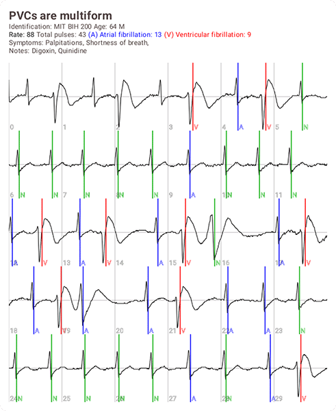 Registro impreso del ECG